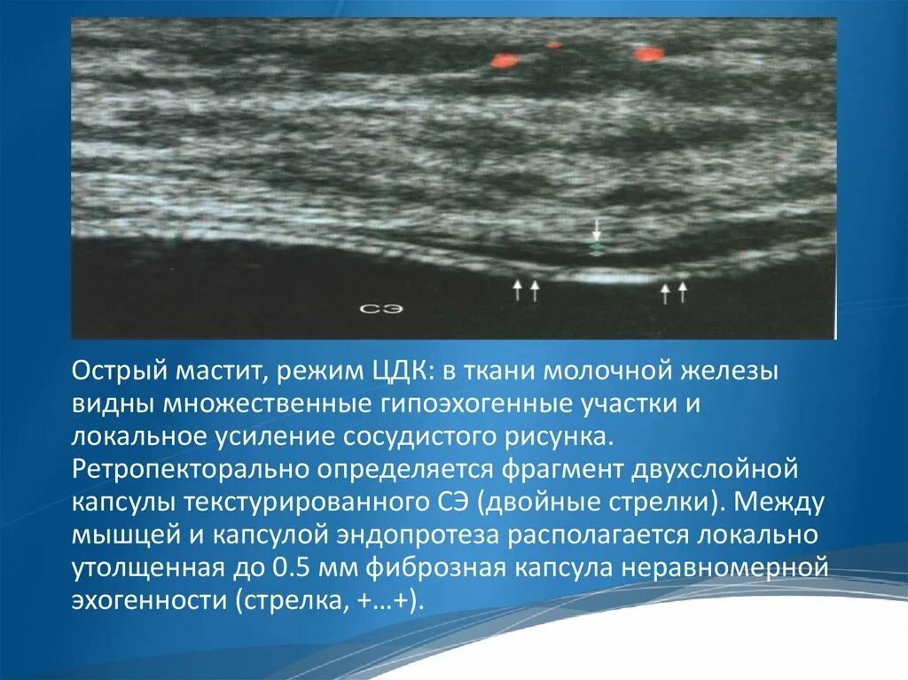 УЗИ молочных желез мастит заключение. Образования молочной железы на УЗИ. Мастит на УЗИ молочных желез. Острый гнойный мастит