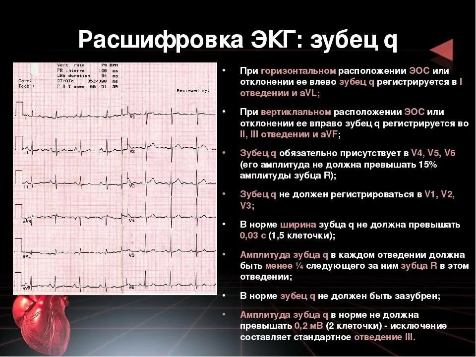 Расшифровка ЭКГ зубец t. Зубцы q r s t ЭКГ. Норма комплекса QRS на ЭКГ У взрослых. QRS норма ЭКГ. Зубцы экг в норме