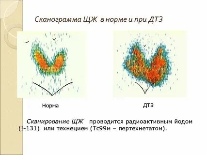 Стенография щитовидной железы