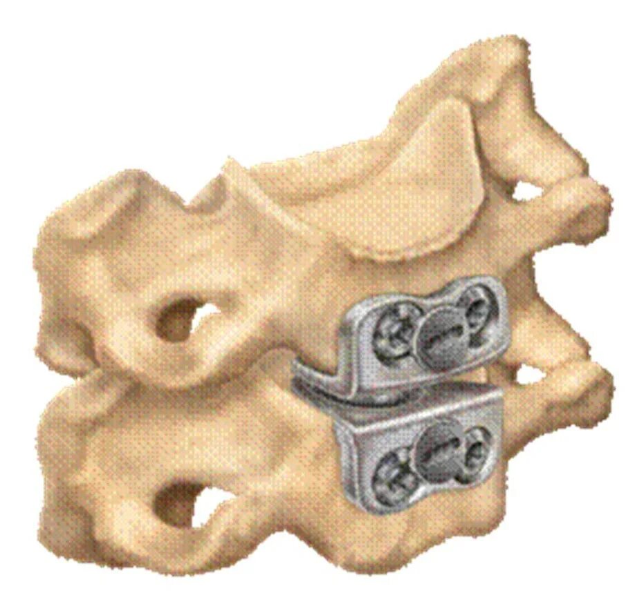 Имплант шейного отдела позвоночника. Медтроник протез межпозвоночного диска. Медтроник протез межпозвонковых диска. Кейдж для позвоночника поясничного отдела. Имплант Кейдж позвоночник.
