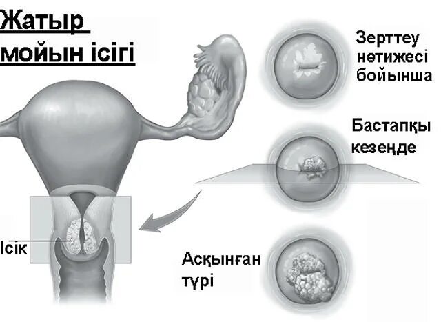 Жатыр ішілік спираль презентация. Цистоэктомия