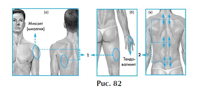 Миозит что это. Воспаление мышц миозит. Схемы терапии миозита спины.