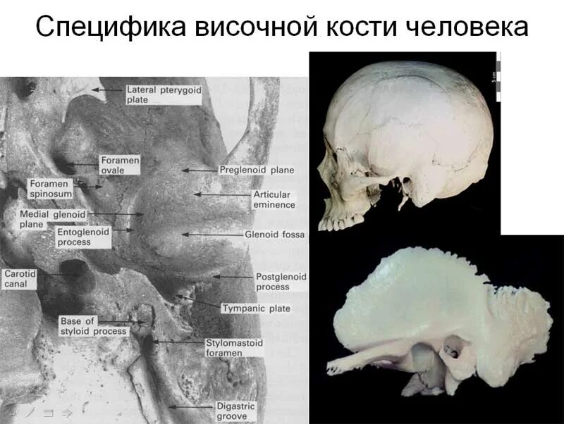 Перелом пирамиды височной кости кт. Дисплазия височной кости. Пирамида (каменистая часть) височной кости. Пирамида височной кости на кт.