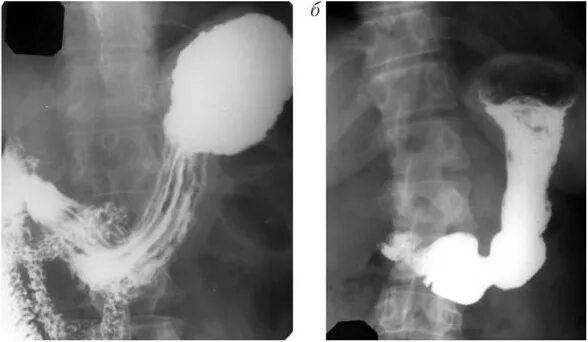 Рентген с барием пищевода и желудка подготовка. Рельеф слизистой оболочки желудка рентген. Рельеф слизистой желудка на рентгене. Бандажирование желудка рентген.