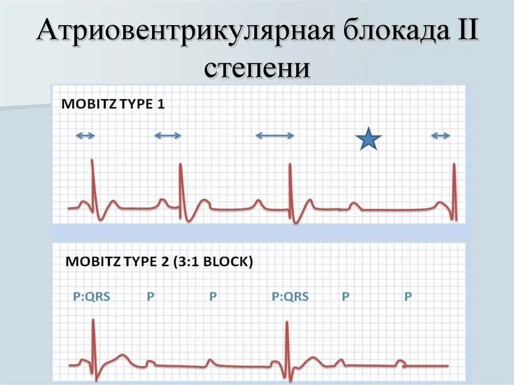 Блокада узла. АВ блокада 2 степени Мобитц 3. АВ блокада 2 степени Мобитц 1 на ЭКГ. Атриовентрикулярная блокада II степени. АВ блокада второй степени Мобиц 1.