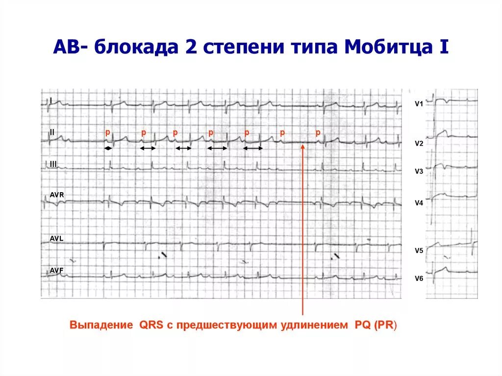 Атриовентрикулярная блокада 2. АВ блокада II степени Тип Мобитц II. АВ блокада 2 степени типа 1 Мобитц 1 это. АВ-блокада 2 степени 1 типа на ЭКГ. Av блокада 2 степени 2 типа.