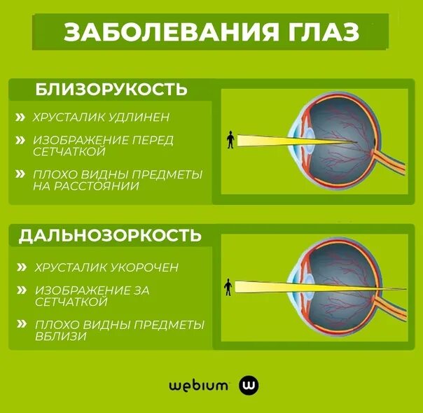 Болезнь дальнозоркость. Дальнозоркость и близорукость строение глаза. Что такое близорукость (миопия) и дальнозоркость (гиперметропия). Таблица заболевания глаз близорукость и дальнозоркость. Близорукость форма хрусталика.