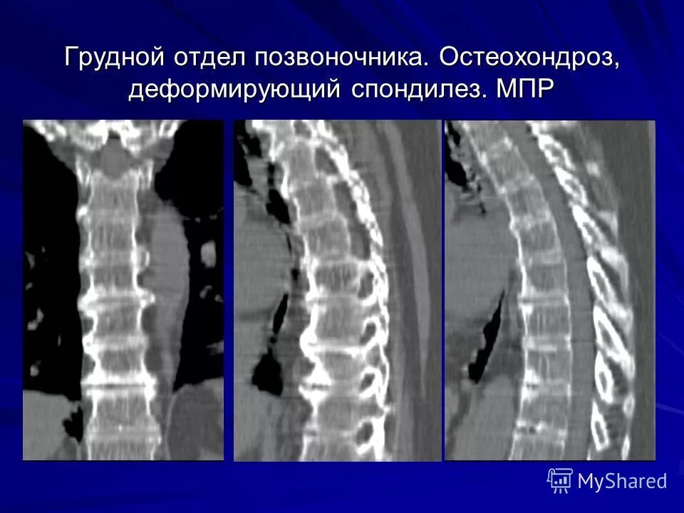 Грудной спондилез лечение симптомы. Деформирующий спондилез рентген. Деформирующий спондилоартроз на кт. Остеохондроз деформирующий спондилез. Деформирующий спондилез l2 l5.