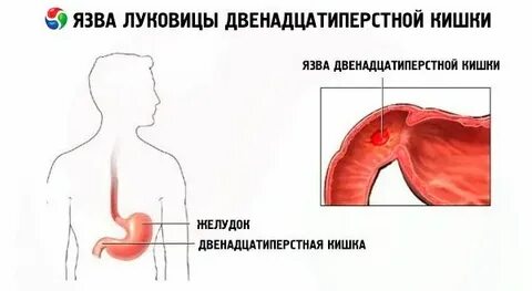 Масло при язве двенадцатиперстной кишки