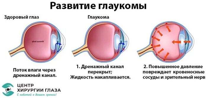 Этапы развития глаукомы. Глаукома схема глаза. Схема операции при глаукоме. Внутриглазное давление при стадиях глаукомы. Глазная операция глаукомы