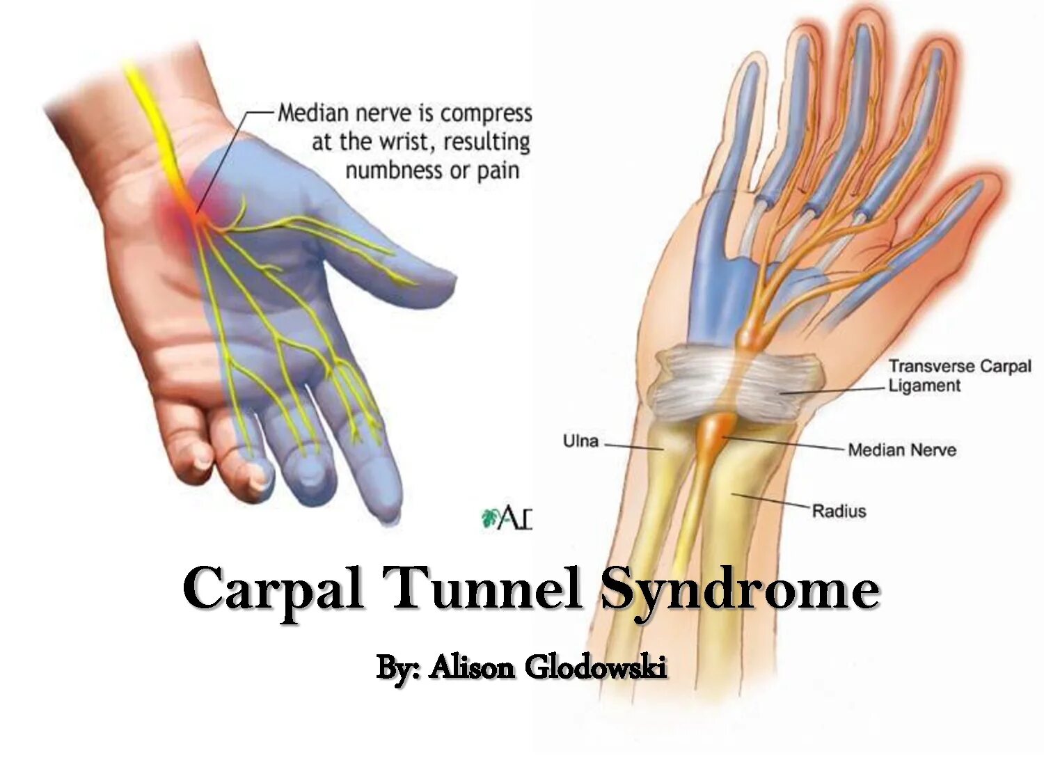 Ноющая боль в пальцах рук. Синдром запястного канала. Нейропатия срединного нерва. Синдром карпального канала запястья. Туннельный синдром запястья кисти.