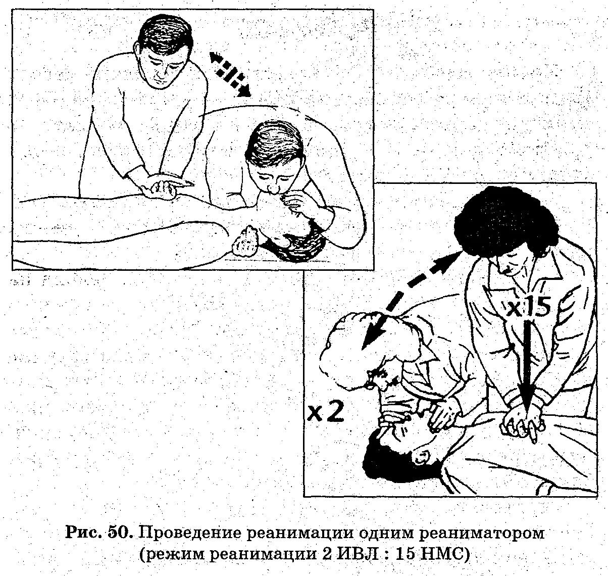 ИВЛ И непрямой массаж сердца алгоритм. Искусственная вентиляция легких и непрямой массаж сердца алгоритм. Сердечно-лёгочная реанимация.