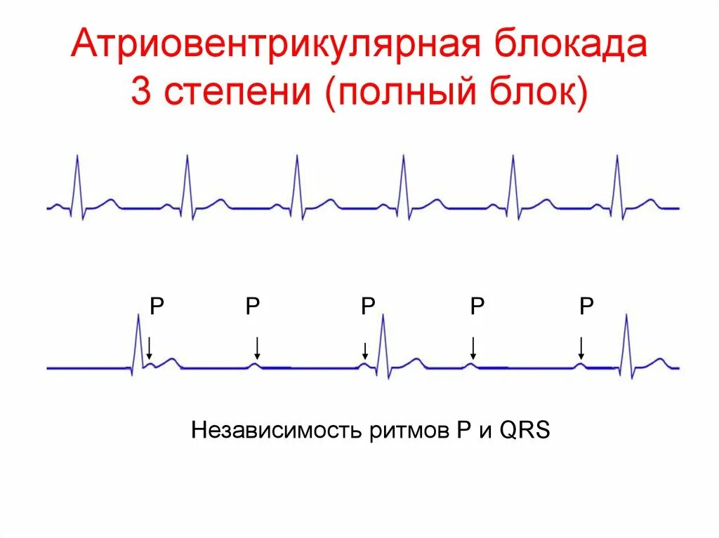 Полная атриовентрикулярная блокада 3 степени на ЭКГ. АВ блокада 3 степени на ЭКГ. ЭКГ АВ блокада 3 степени ЭКГ. Полная АВ блокада 3 степени ЭКГ. Fuller av