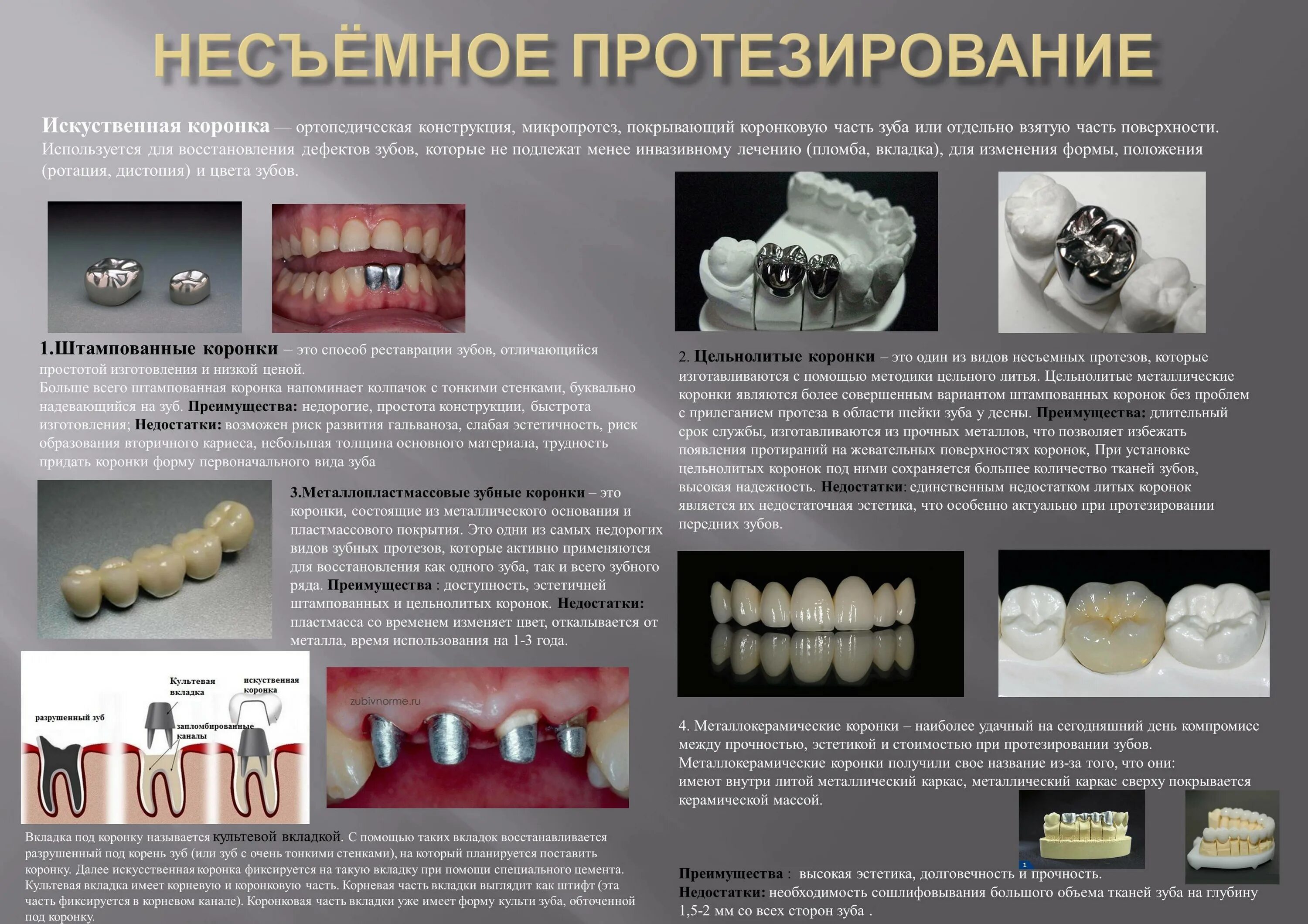 Коронка штампованная стальная восстановительная. Фиксация штампованнокоронки. Металлокерамика коронки на жевательные зубы. Мостовидный протез металлокерамика. Протезист рейтинг