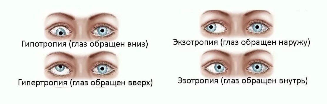 Астигматизм у детей гимнастика для глаз. Болезнь глаз астигматизм. Астигматизм это косоглазие. Миопия гиперметропия астигматизм. Астигматизм это простыми словами.