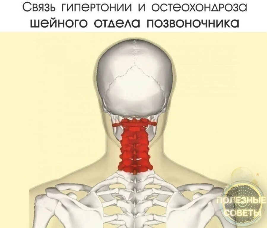 остеохондроз и гипертония взаимосвязь. скачки артериального давления при шейном остеохондрозе. остеохондроз и давление связь. шейный хондроз и давление. остеохондроз и давление связь.
