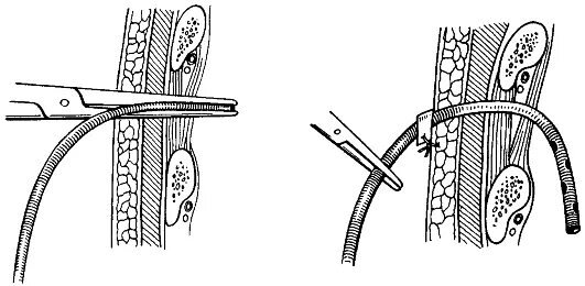 метод дренирования ран. трансторакальное дренирование абсцесса. пневмоторакс дренирование плевральной. проточно-аспирационное дренирование. дренирование кисты по мональди.