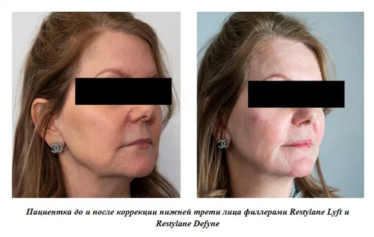 Инъекции Диспорта в межбровные морщины filler.by