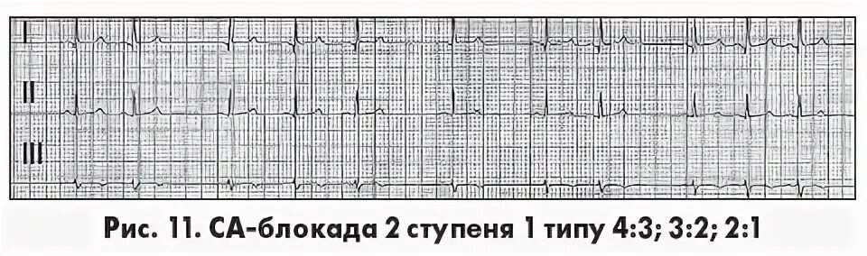 Са блокада 2 тип. Са блокада 2 степени 1 типа на ЭКГ. Синоатриальная блокада 2 степени 1 типа. Са блокада 2 Тип 1. Са блокада 2 ст 1 типа.