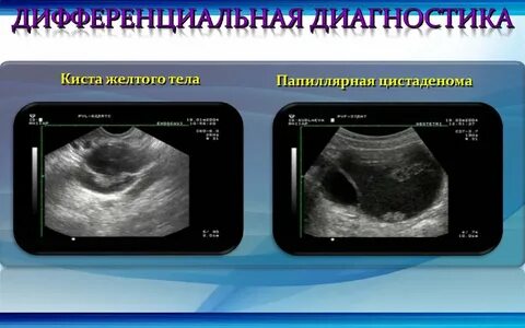 Эндометриоидная киста желтого тела