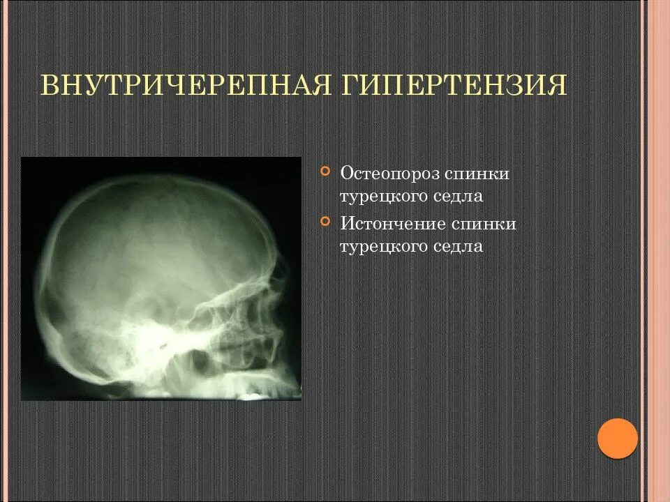 Рентгенологические признаки внутричерепной гипертензии. Внутричерепное давление на рентгене черепа. Изменения турецкого седла на рентгене. Рентгенограмма турецкого седла.