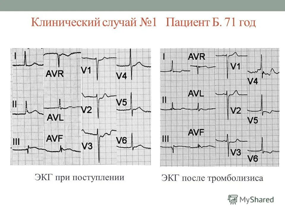 аневризма аорты на экг. аневризма аорты на экг. расслаивающая аневризма аорты на экг. инфаркт миокарда передней стенки лж экг. расширение аорты на экг.