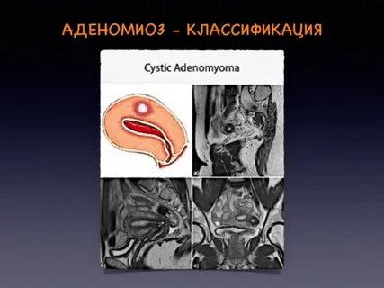 Аденомиоз это у женщины простыми словами