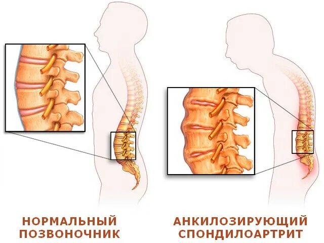 Спондилоартрит у детей. Ювенильный анкилозирующий спондилит. Спондилоартрит у детей. Болезнь бехтерева-анкилозирующий. Спондилоартрит у детей.