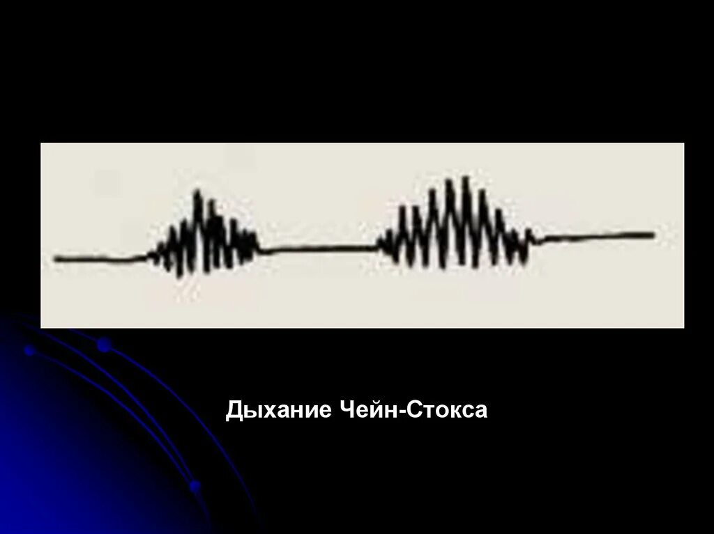 Дыхание биота чейна стокса куссмауля. Дыхание чейна-стокса рисунок. Патологическое дыхание куссмауля чейна-стокса. Дыхание чейна стокса. Дыхание типа чейна-стокса характеризуется.
