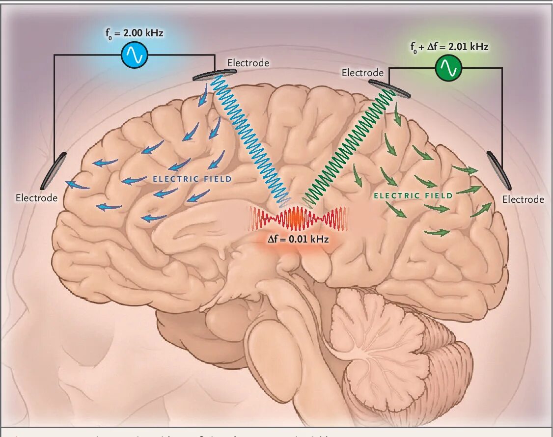 Deep brain. ДИИП брайин Стимулейшн. Глубокая стимуляция головного мозга вектор. Brain stimulation игра. Mer Deep Brain stimulation.