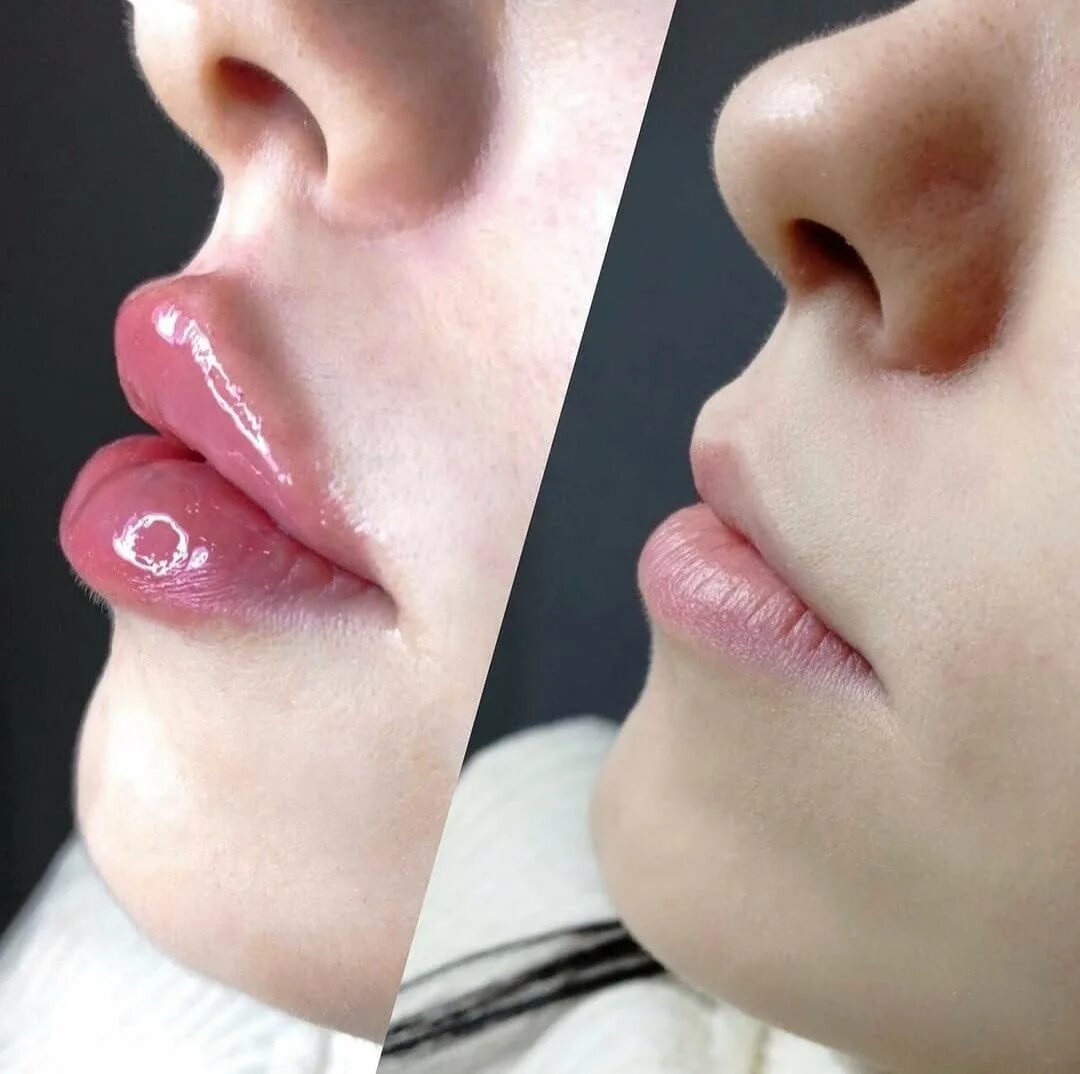 Что такое аугментация губ. Косметолог губы.