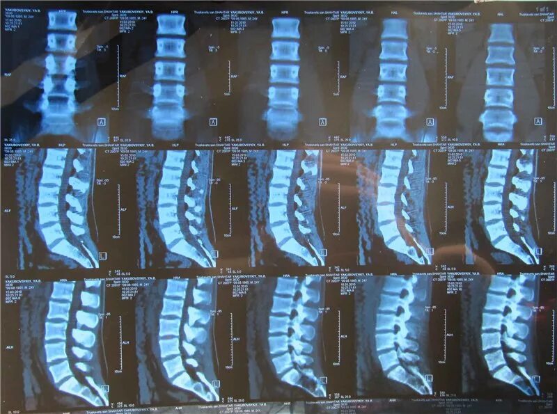Мрт пояснично-крестцового отдела позвоночника остеохондроз. Остеохондроз грудного отдела позвоночника мрт. Остеохондроз поясничного отдела мрт. Мрт крестцового отдела позвоночника. Можно делать кт позвоночника