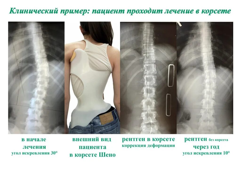 Корсет Эббота-Шено. Корсет Шино Шино. Корсет Шено при s образном сколиозе. Сколиоз 3 степени корсет Шено. Лечение позвоночника после операции