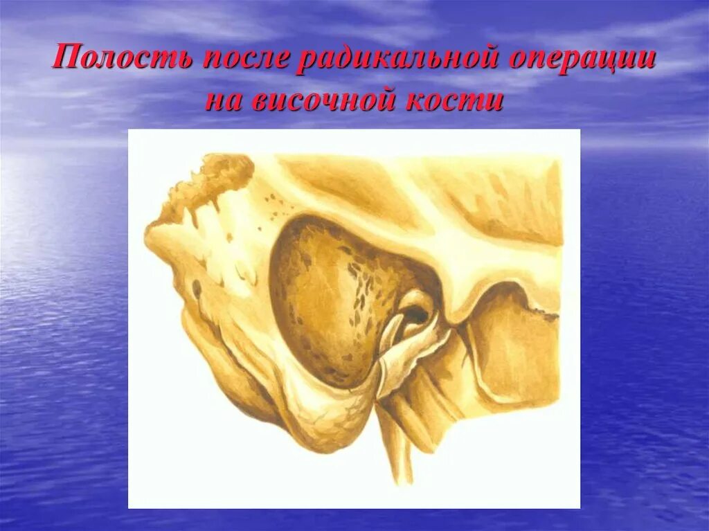 Полость после операции. Полость после радикальной операции. операция на височной кости. кариес височной кости. послеоперационная полость после радикальной операции на ухе.