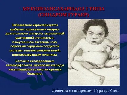 Различные синдромы