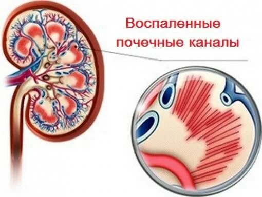 Почка пораженная гломерулонефритом. Почечные канальцы. Воспаление клубочков почек. Канальцевое поражение почек. Поражение клубочков почек