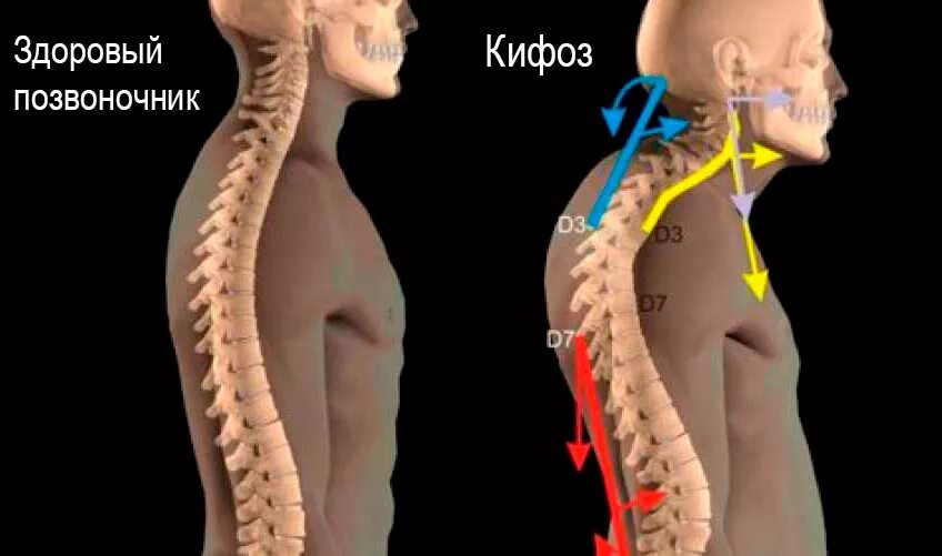 Кифоз и лордоз шейного отдела. Кифоз шейного отдела позвоночника. Позвоночник шейный кифоз. Кифоз лордоз грудного отдела позвоночника.