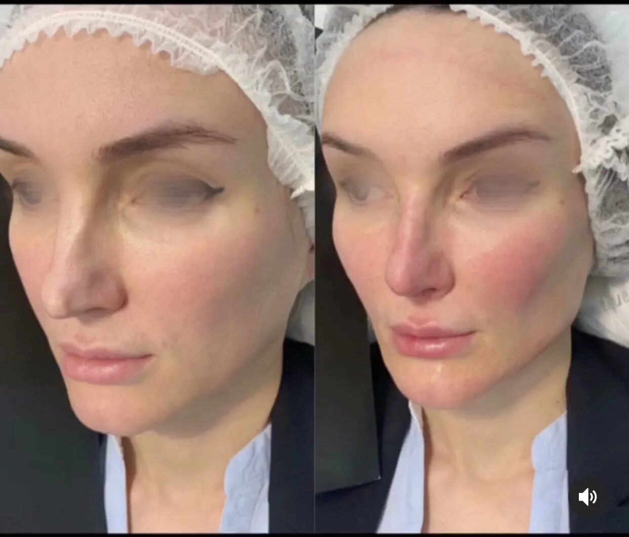 Увеличение скул до и после женщины Pin on Cosmetic Procedures
