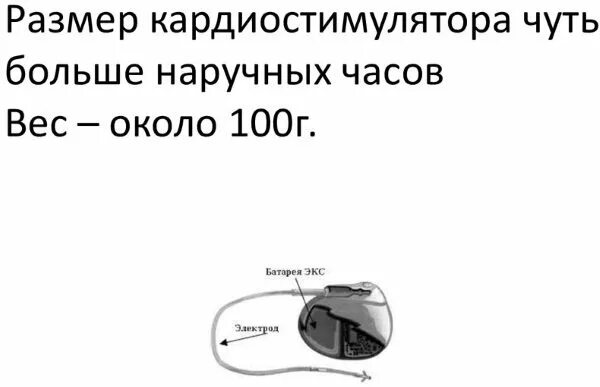 Кардиостимулятор Размеры. Установка кардиостимулятора. Установка однокамерного кардиостимулятора. Почему в инструкции людям с кардиостимуляторами запрещается