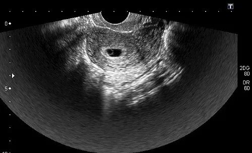 когда можно увидеть эмбрион. когда можно увидеть эмбрион. когда можно увидеть эмбрион. узи эмбриона на 6 недели что видно. плодное яйцо 6 недель по узи.