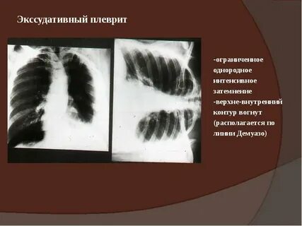 Правосторонний плеврит