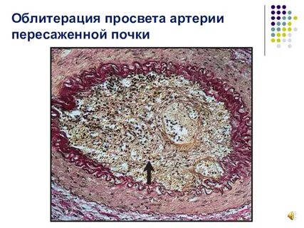 Облитерация это