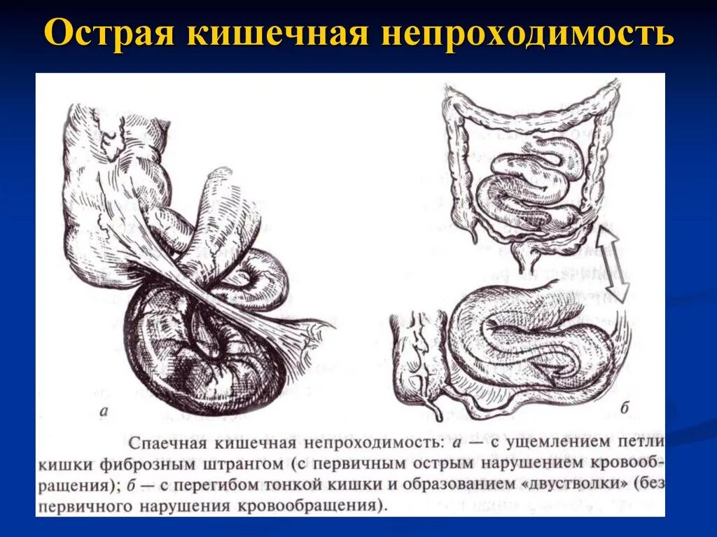 Симптомы операция кишечнике. Кишечная непроходимость Госпитальная хирургия. Острая кишечная непроходимость операция. Механическая кишечная непроходимость хирургия. Симптомы кишечной непроходимости хирургия.