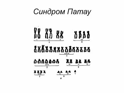 Для синдрома патау характерен кариотип