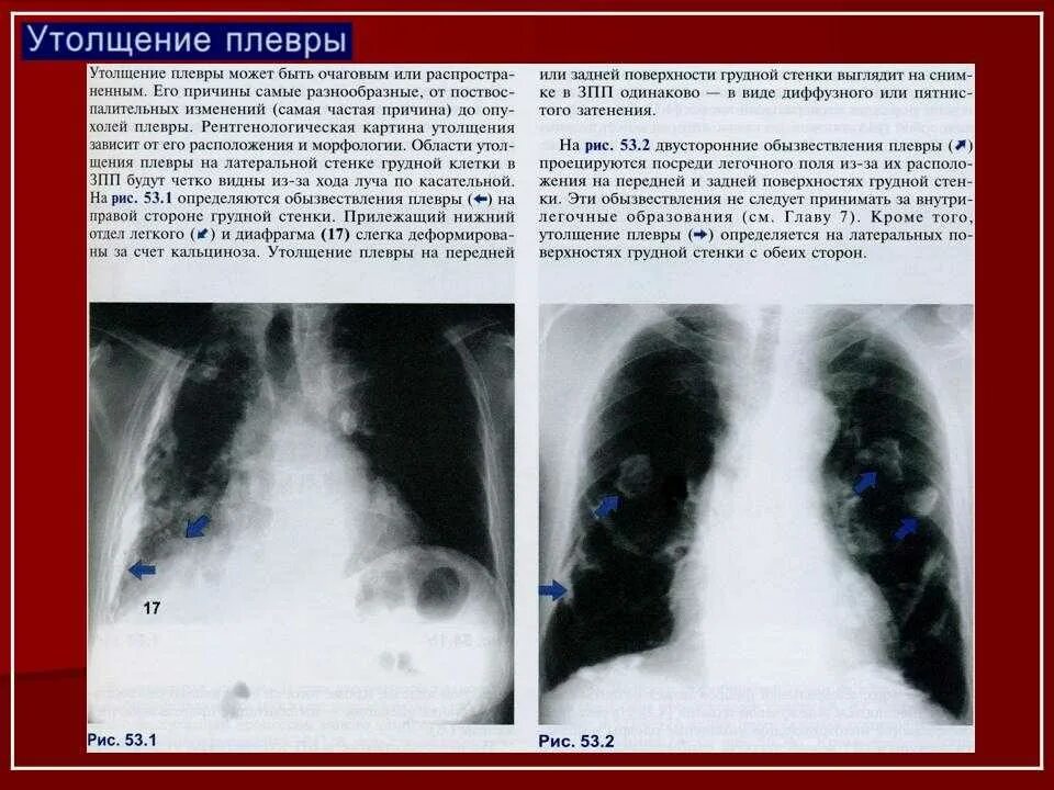 Апикальные спайки