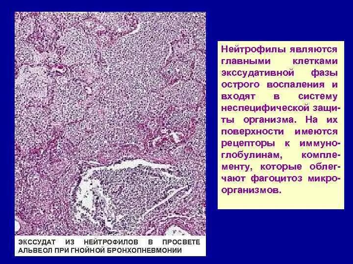 Экссудативное воспаление. Экссудативный Тип воспаления. Опорно трофические ткани кровь и лимфа. Главные клетки экссудативного воспаления.. В очаге острого воспаления нейтрофилы секретируют