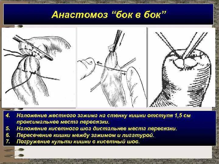 Алгоритм операции наложения. Этапы формирования кишечного анастомоза бок в бок. Кишечный шов анастомоз бок в бок. Кишечный анастомоз бок в бок техника.