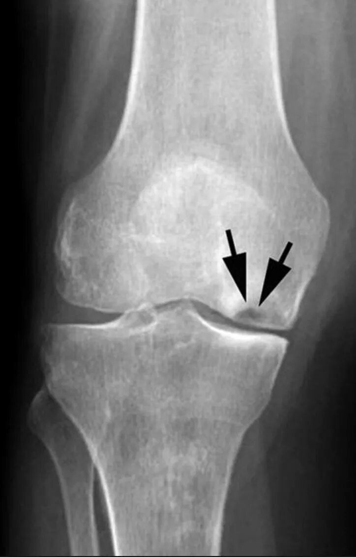 Некроз мыщелков. Асептический некроз коленного кости. Остеонекроз коленного сустава рентген. Асептический некроз лучевой кости. Асептический некроз большеберцовой кости.
