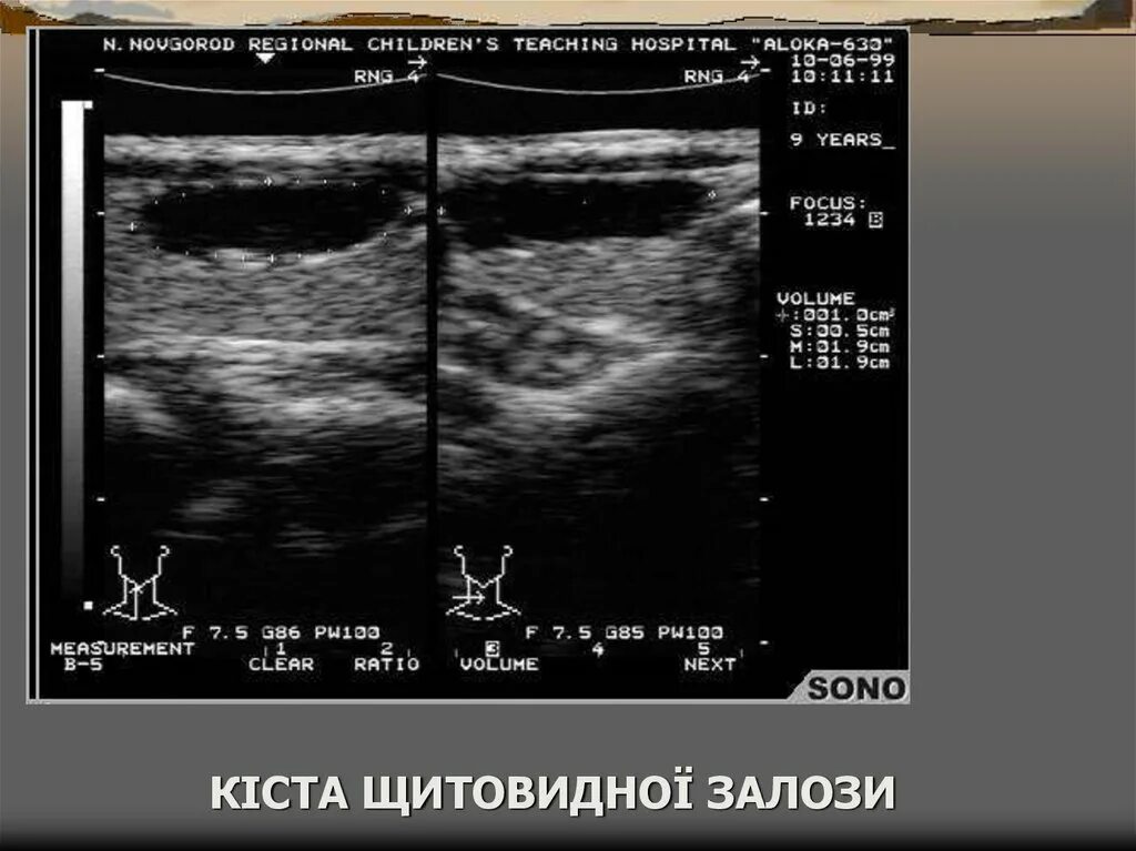 Железы кистозно расширены. Киста щитовидной железы. Киста щитовидной железы на УЗИ. Фолликулярные кисты щитовидной железы на УЗИ. Киста на щитовидной железе фото.