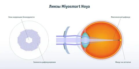 Линзы miyosmart отзывы